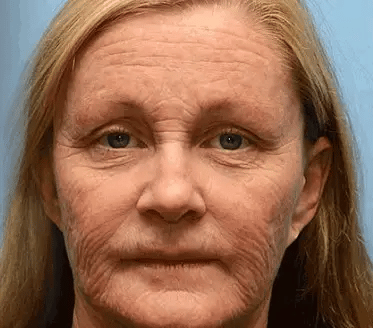 LOVILDS™ Bee Essence Skin Antibacterial Cream—used to treat a variety of skin diseases (AAD recommended)