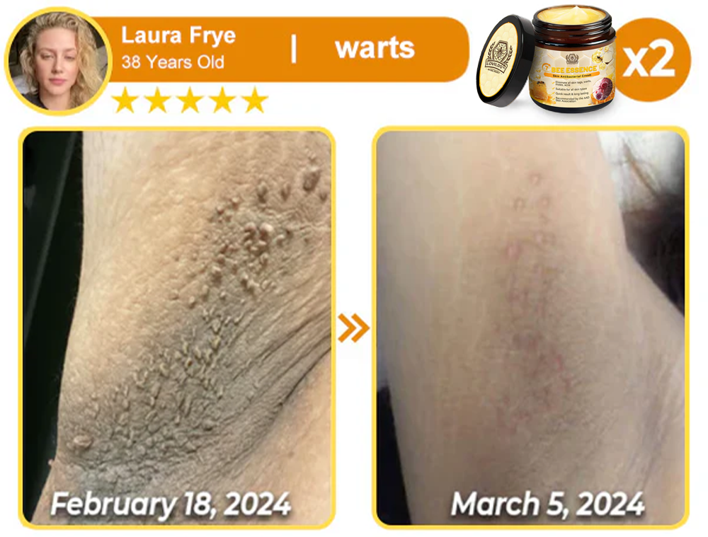 LOVILDS™ Bee Essence Skin Antibacterial Cream—used to treat a variety of skin diseases (AAD recommended)