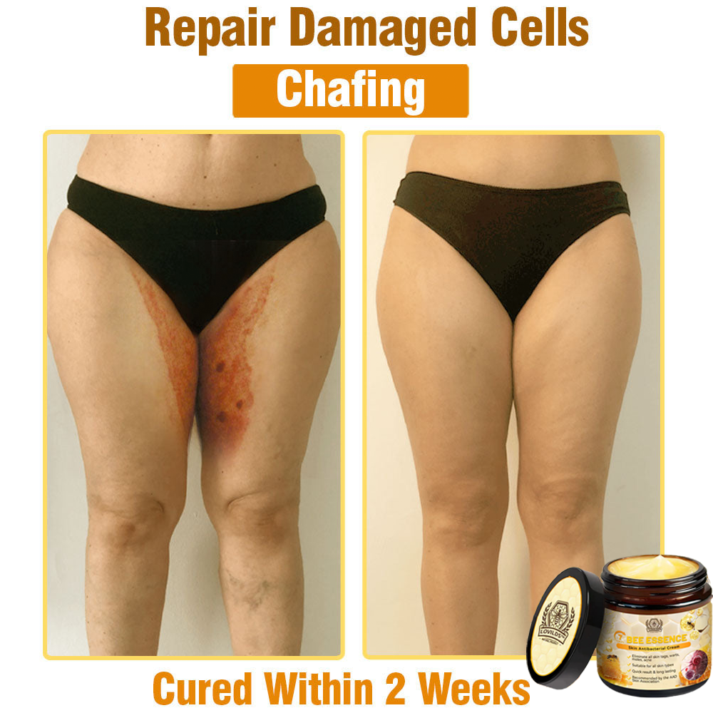 LOVILDS™ Bee Essence Skin Antibacterial Cream—used to treat a variety of skin diseases (AAD recommended)