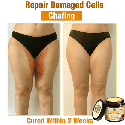 LOVILDS™ Bee Essence Skin Antibacterial Cream—used to treat a variety of skin diseases (AAD recommended)