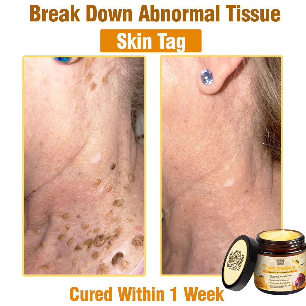 LOVILDS™ Bee Essence Skin Antibacterial Cream—used to treat a variety of skin diseases (AAD recommended)