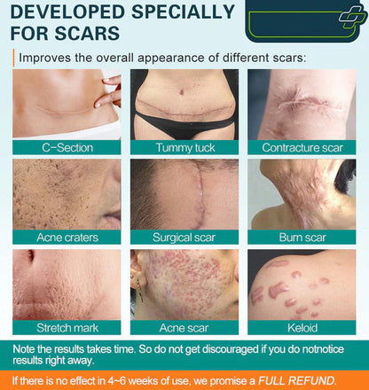 HZA Advanced Scar Spray For All Types of Scars - For example Acne Scars, Surgical Scars and Stretch Marks ⚡️⚡️⚡️